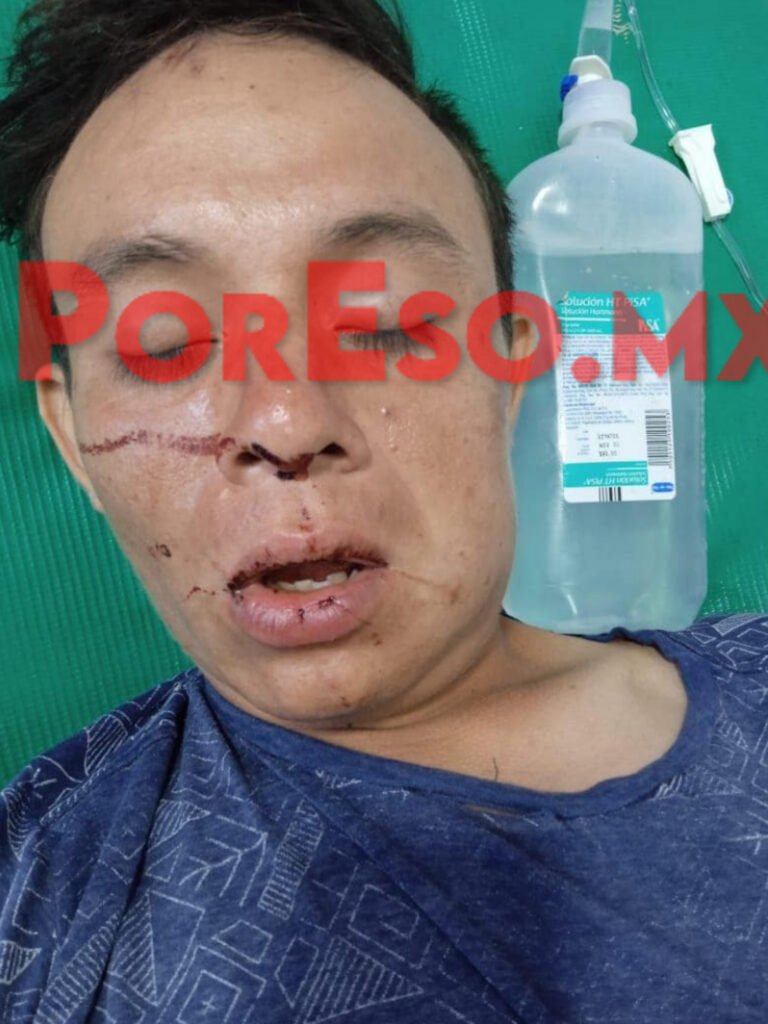 Policías fracturaron mandíbula a joven detenido; Alcalde de Tixkokob Fabián Rivera, se mantiene en silencio